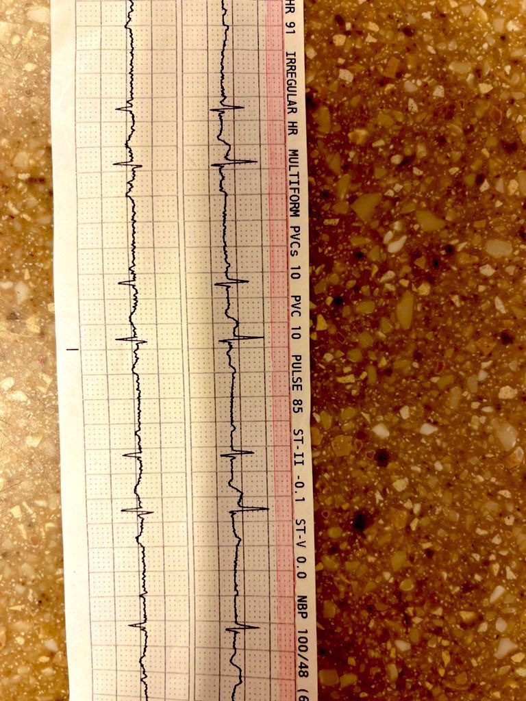 Christiano963's tweet photo. Presenting a male patient with Mitral Regurgitation, non-collapse. Please,  feel free to input your educational rhythm interpretation. https://t.co/EpynZcCcK8