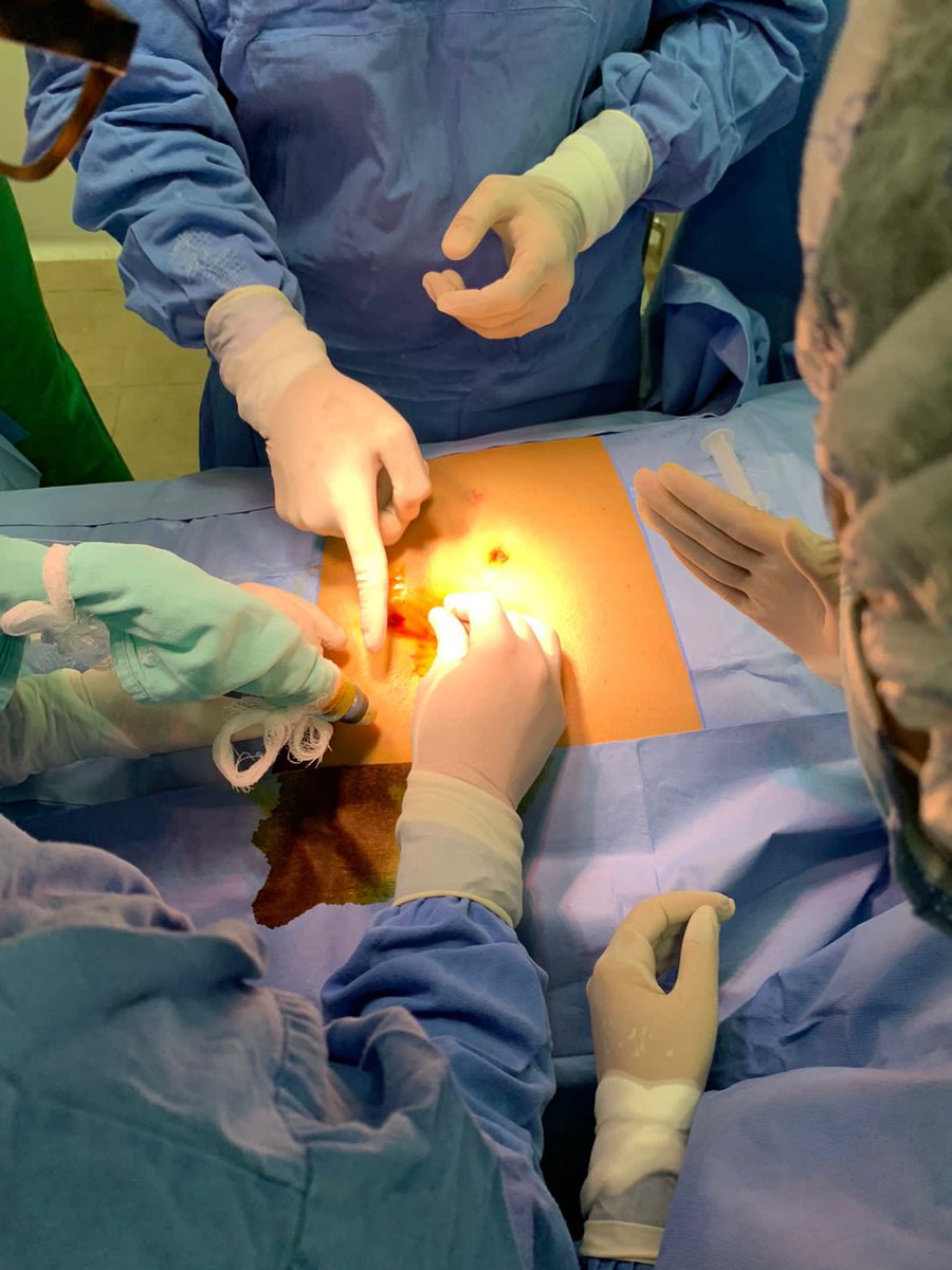 Nefrología INC (@nefrologiainc) on Twitter photo 💥 Percutaneous peritoneal dialysis catheter insertion 💥 short 🧵
#Nephrology #InterventionalNeprology <a href="/ISNkidneycare/">Int Society of Nephrology</a>
Success depends (amongst other variables) on access to the peritoneum, so USG is fundamental 💥 Percutaneous peritoneal dialysis catheter insertion 💥 short 🧵
#Nephrology #InterventionalNeprology <a href="/ISNkidneycare/">Int Society of Nephrology</a>
Success depends (amongst other variables) on access to the peritoneum, so USG is fundamental
