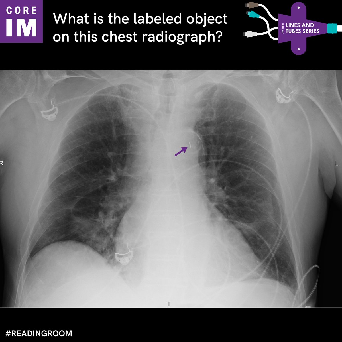 CORE IM (@coreimpodcast) on Twitter photo 1/ Good day, #MedTwitter, and welcome to the latest installment of #ReadingRoom. Dim the lights, and prepare to correlate clinically! 
Take a look at the x-ray below: what is the labeled object? (hint: where is it?) 1/ Good day, #MedTwitter, and welcome to the latest installment of #ReadingRoom. Dim the lights, and prepare to correlate clinically! 
Take a look at the x-ray below: what is the labeled object? (hint: where is it?)