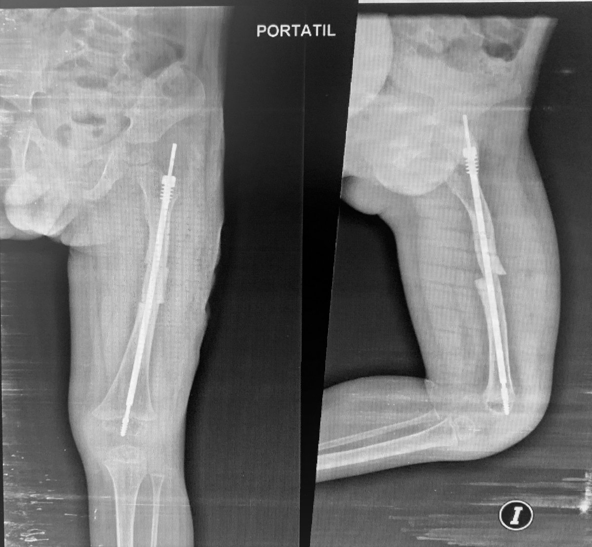 DocVictorVargas's tweet photo. 2,5a. Fractura de Fémur y recurvatum, Osteogénesis Imperfecta. Fijación con Clavo Telescópico Fassier Duval.
2,5a. Femur fracture and recurvatum, Osteogenesis Imperfecta. Fixation with Fassier Duval Telescopic Nail. 
#OsteogenesImperfecta #HuesosDeCristal #BrittleBone https://t.co/iF915di2hA