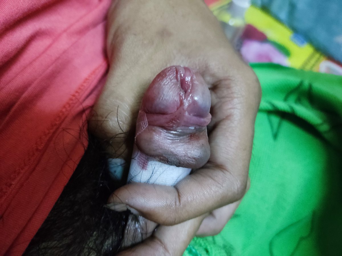 ‼️🔮รับฝังมุก อุปกรณ์สะอาดปลอดภัย
เน้นคุณภาพ พร้อมยาชา 💉 ✅‼️
🔮 8มิล 1 เม็ด + ยาชา    5️⃣0️⃣0️⃣‼️
🔮 8มิล 2 เม็ด + ยาชา    9️⃣0️⃣0️⃣‼️
🔮 8มิล 3 เม็ด + ยาชา    1️⃣3️⃣0️⃣0️⃣‼️
🔮 10มิล 1 เม็ด + ยาชา  6️⃣0️⃣0️⃣‼️
🔮 10มิล 2 เม็ด + ยาชา  1️⃣0️⃣0️⃣0️⃣‼️
🔮 10มิล 3 เม็ด + ยาชา  1️⃣6️⃣0️⃣0️⃣‼️