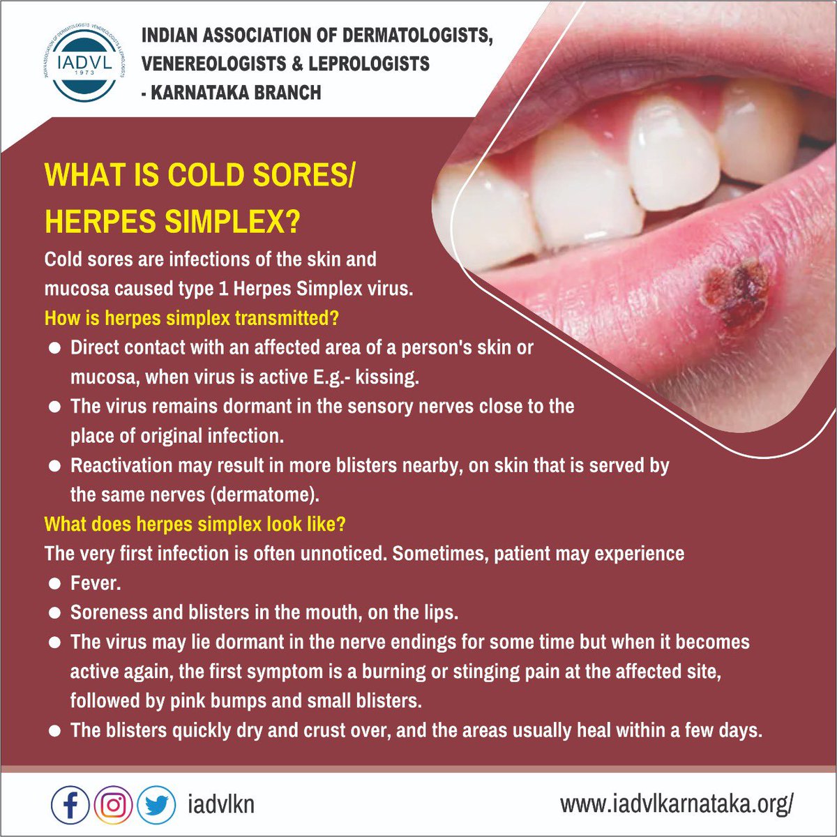 Herpes labialis or cold sores are a common viral infection. They can be treated easily ! Consult a dermatologist #skin #dermatology #iadvl #coldsores