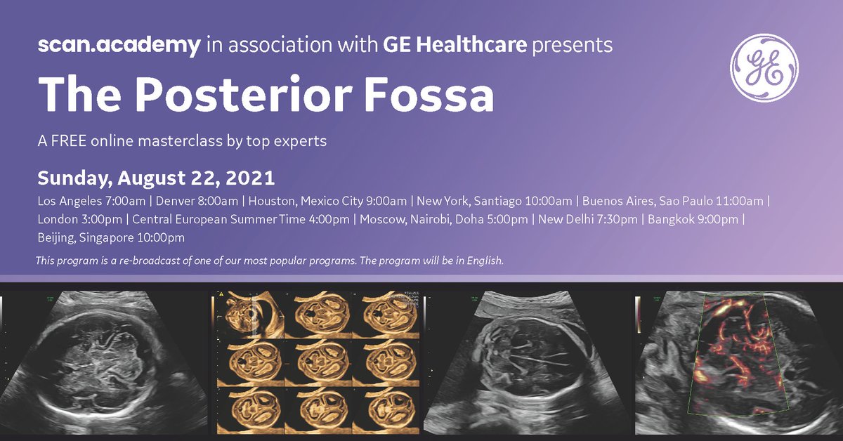 Join on August 22, 2021 for the re-broadcast of “The Posterior Fossa – imaging, assessment and prognosis of abnormalities” with international top experts G. Pilu, D. Prayer, S. Meagher, P. Acharya and A. Papageorghiou. Register now: webinaronline.in/Scan_Academy/2…