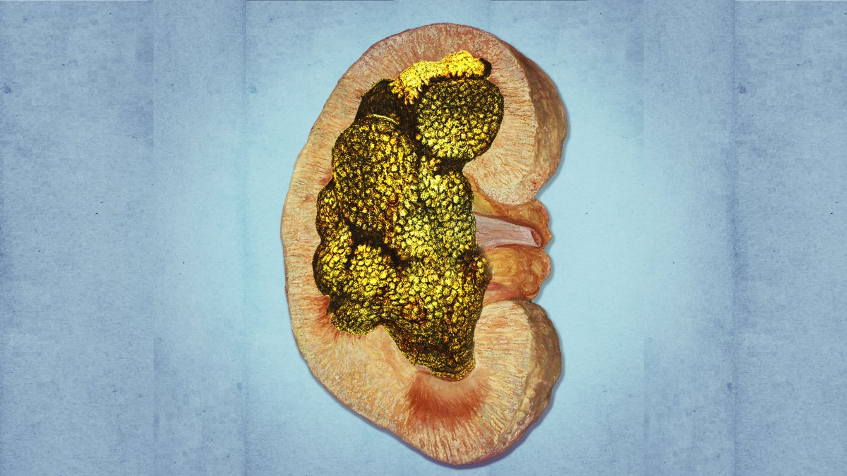 NEW VIDEO: A Man Felt Pain In His Back. This Is What Happened To His Kidney. -RT!

youtu.be/3E75UvmY9GA