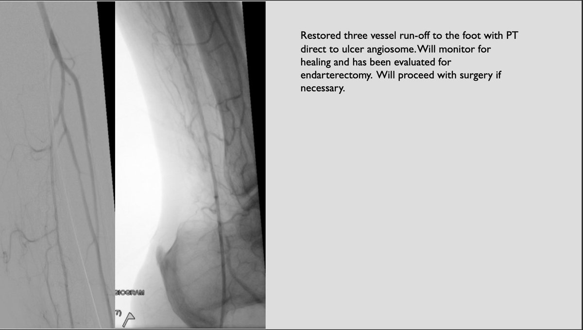 First 🇺🇸 case with <a href="/PhilipsHealth/">Philips Healthcare</a> 1.5 Phoenix atherectomy.  Ca++ occluded CFAs preclude access.  Iliac occlusion treated transradial. 4Fr access to PT with 1.5 Phoenix making short work of tibial calcium.  Restored three vessels to the wound. #irad #CLIfighters #HumbledandHonored