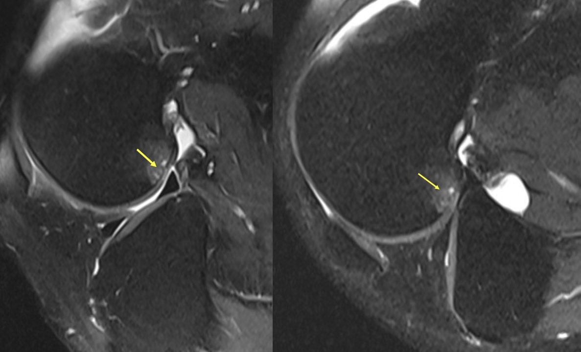 MarceloBordalo's tweet photo. Flexions with simulation of symptoms were performed. On MR, there is no meniscal dislocation, however the osteochondral lesion is shown to be a shadow lesion to posterior horn of lateral meniscus. #meniscalinstability #kneesurgery https://t.co/8EFEVZgFGn