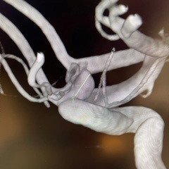 Rapid Medical (@rapid__medical) on Twitter photo Another fantastic #Comaneci case with Dr. Geoffrey Colby @drgeoffreycolby at <a href="/UCLAHealth/">UCLA Health</a>! Dr. Colby treated this 5mm left ICA aneurysm with Comaneci delivered with a Phenom 21. Another fantastic #Comaneci case with Dr. Geoffrey Colby @drgeoffreycolby at <a href="/UCLAHealth/">UCLA Health</a>! Dr. Colby treated this 5mm left ICA aneurysm with Comaneci delivered with a Phenom 21.