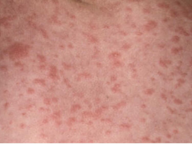 Indiana University Infectious Diseases Fellowship tweet media