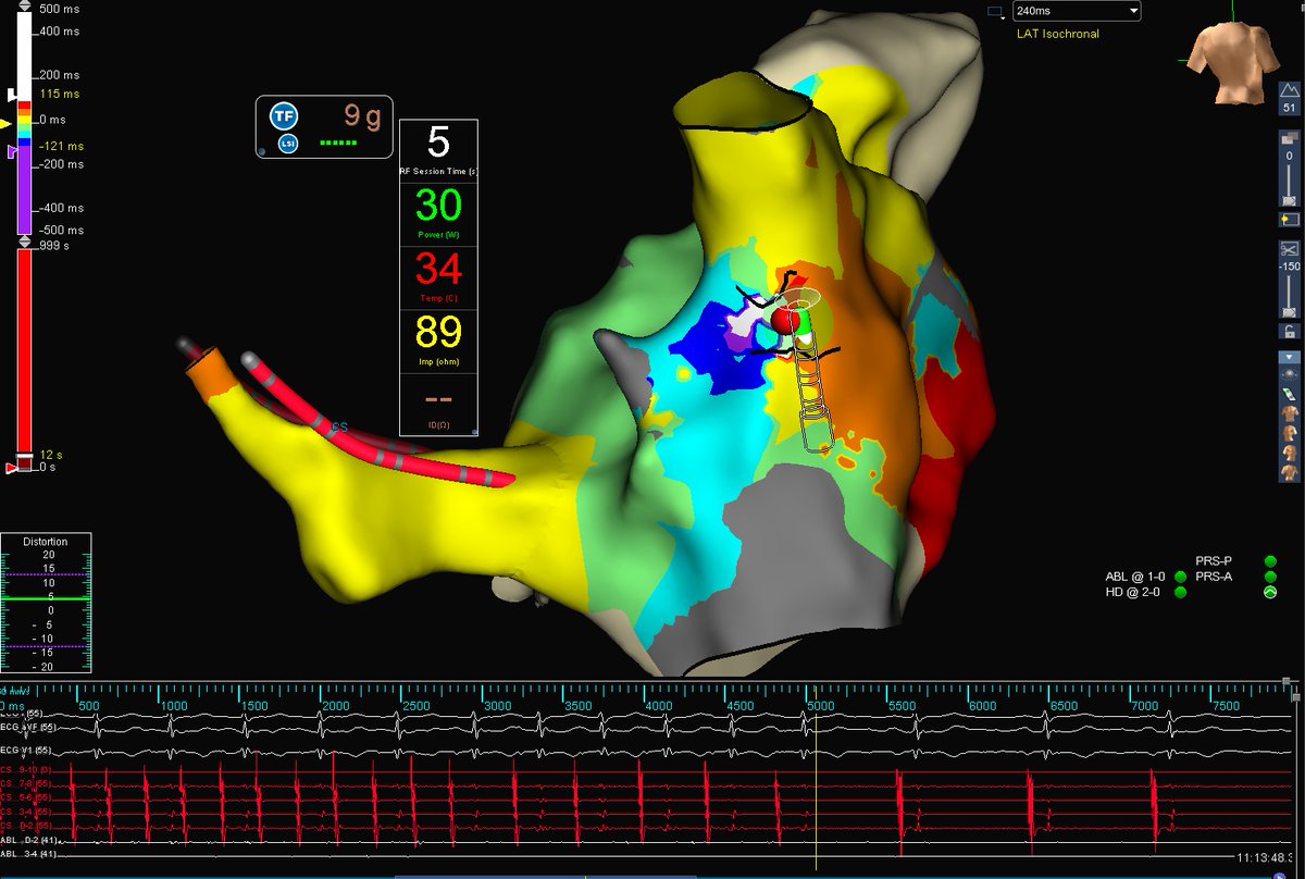 Santosh Padala (@santosh_padala) on Twitter photo Unusual RA postero-septal AFL. 90% TCL on HD grid. One burn termination. @araymondpaquin <a href="/Dr_Santangeli/">Pasquale Santangeli</a> <a href="/pranav_mankad/">Pranav Mankad</a> #EPeeps <a href="/KennethEllenbo1/">Kenneth Ellenbogen</a> Unusual RA postero-septal AFL. 90% TCL on HD grid. One burn termination. @araymondpaquin <a href="/Dr_Santangeli/">Pasquale Santangeli</a> <a href="/pranav_mankad/">Pranav Mankad</a> #EPeeps <a href="/KennethEllenbo1/">Kenneth Ellenbogen</a>