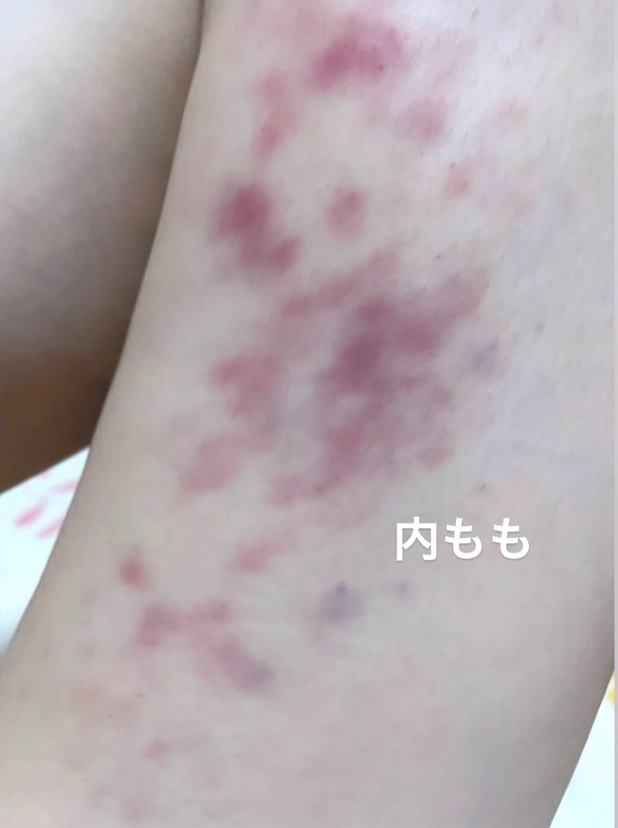痩身エステでアザだらけ 内出血や赤くなる原因と対処法