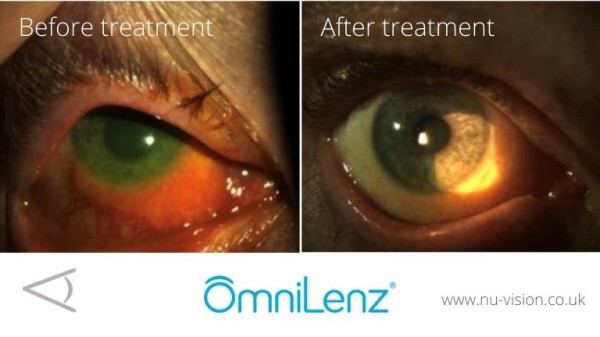 The below images show the use of Omnigen® to treat epithelial defects caused by an alkali injury. Two weeks following the application. The defect of the cornea and conjunctiva was completely resolved, and the patient was discharged. 
  
Source: https:/... tinyurl.com/yjfsv5am