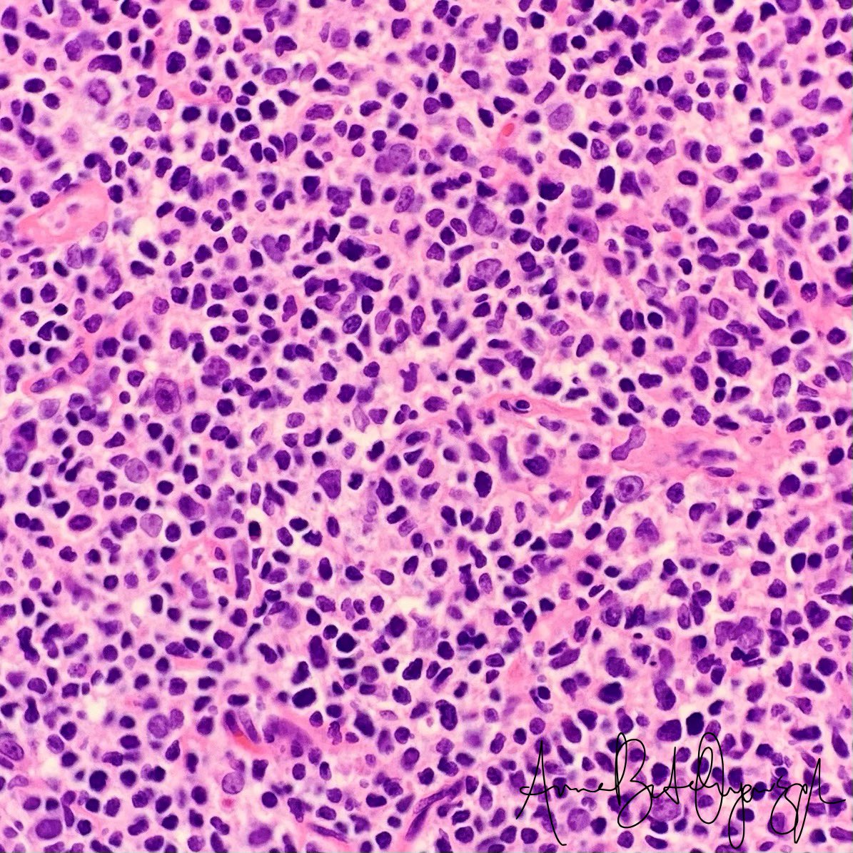 Middle-aged patient with bowel thickening. What’s your differential diagnosis? #hemepath #gipath