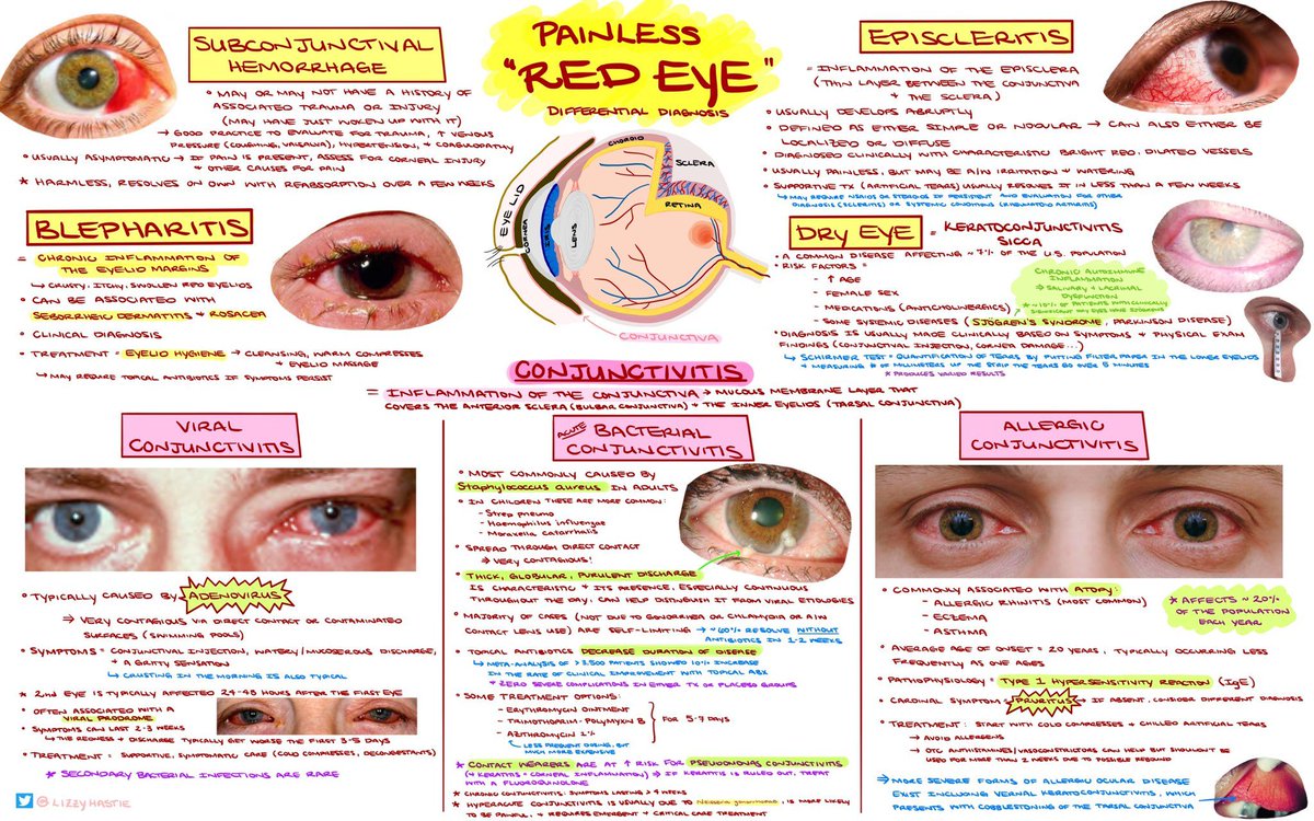 Painless Red Eye - Differential Diagnosis Framework by @LizzyHastie grepmed.com/?q=painless+re… #FOAMed #MedEd #Ophthotwitter