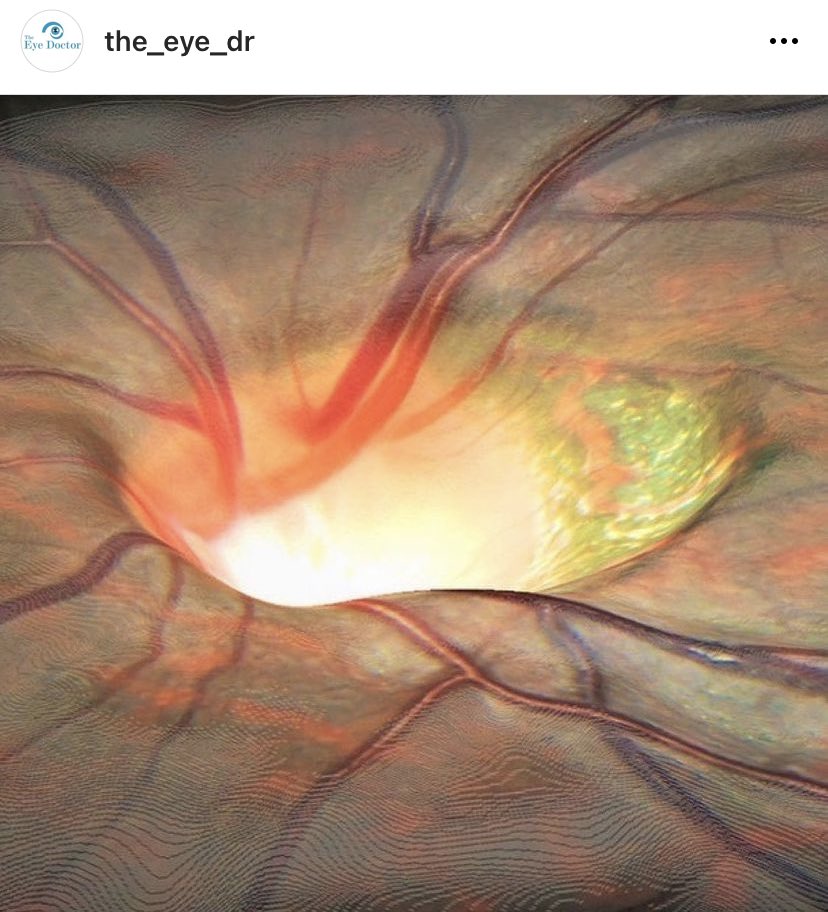 Hay imágenes bellísimas del ojo, pero esta imposible no compartirla.
Nervio óptico en un paciente con glaucoma (the silent taker of sight). No es mía es de Dr Eye de Londres.