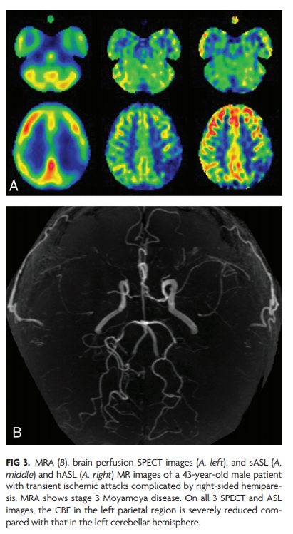 TheAJNR's tweet photo. "Diagnostic Accuracy of Screening Arterial Spin-Labeling MRI Using Hadamard Encoding for the Detection of Reduced CBF in Adult Patients with Ischemic Moyamoya Disease" |  #NeuroRad | https://t.co/GOGXE2VF1W https://t.co/sIBVrJO4Ax