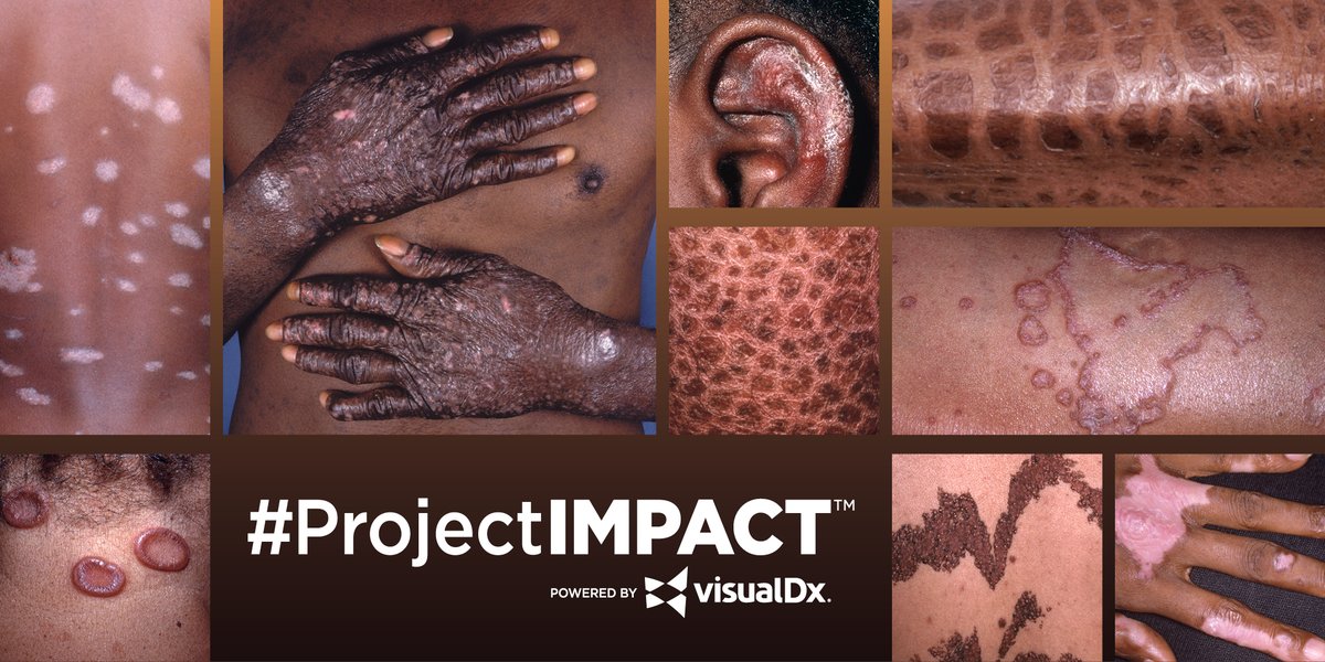 Project IMPACT is a global effort powered by <a href="/VisualDx/">VisualDx</a> to reduce disparities in medicine. Visit projectimpact.org to view tools that bridge gaps of knowledge and improve care #HealthEquity #MedTwitter #DermTwitter #RacialDisparities #Dermatology #SkinofColor #ProjectIMPACT