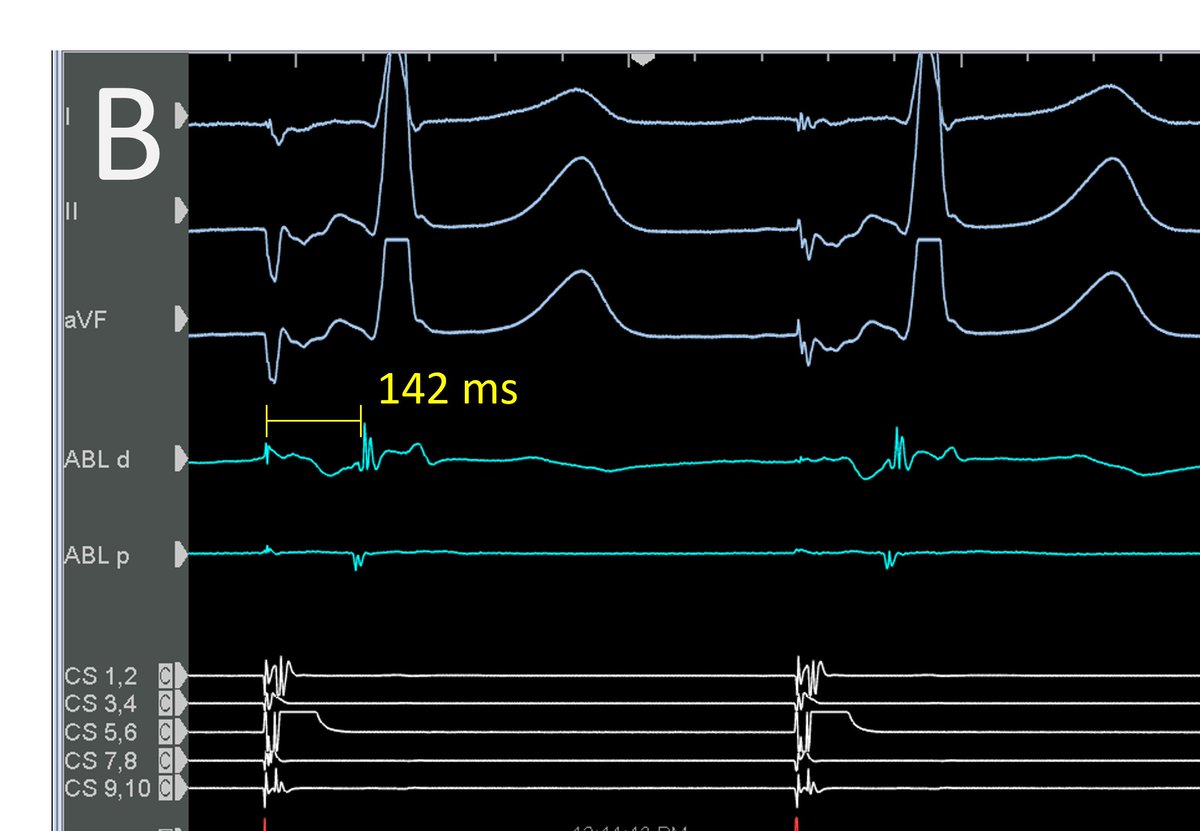 Fair amount of ablation across CTI for typical flutter.  Here are persistent egm timings on lateral side of line during CS os pacing.  What to do next? 🙄
#FlutterWoes
<a href="/EPeeps_Bot/">EP_Bot</a> #EPeeps