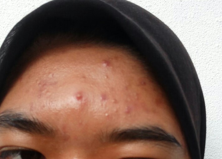 skinnshope's tweet photo. How @alluskinhq works on my skin. My skin breakout sebab product lain but Alluskin save them 😘

@draensaari @alluskinhq @alluskin_qiela https://t.co/qduGqi3CfG