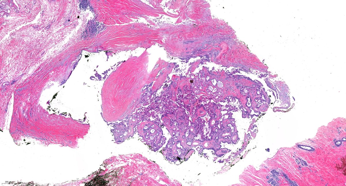 PoloniaAntonio's tweet photo. F, mid-40s, breast nodule. Any IHC?😃
#BreastPath @atman_ci @ADamronMD @LizaMQuintana @DrGeeONE @tlabiano @AnapathResident @ariella8 @kriyer68 @DrNishatAfroz2 @AnatPathLouis @Histopatolomon @crisdelarco @DrBMcGinn @padmapathology1 @nucleololailo @JPintoPath @TheKarenPinto https://t.co/5vrnEFyShy