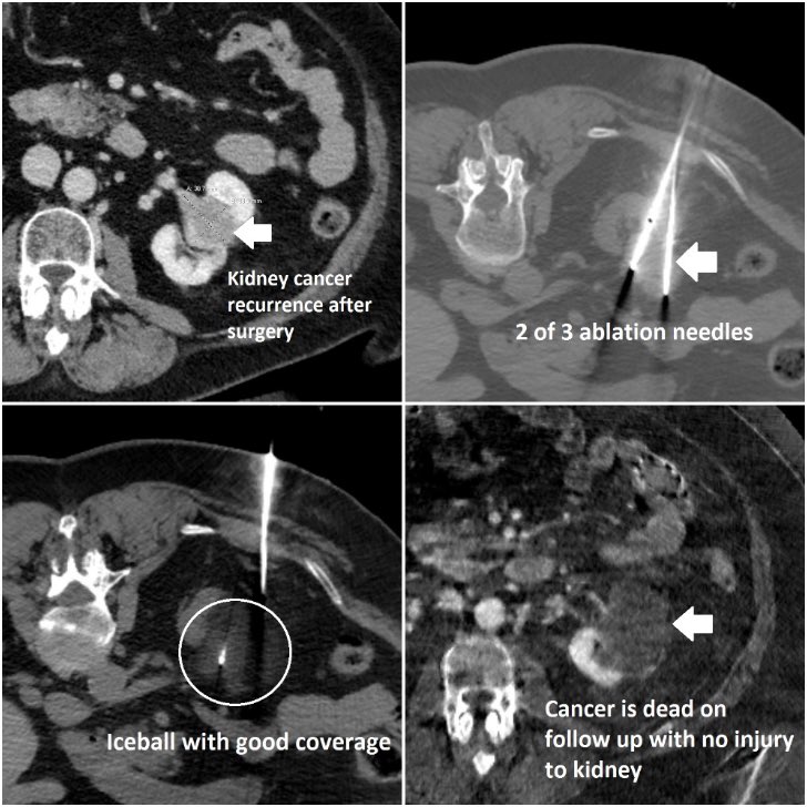 Central recurrence of renal cell #cancer after prior partial nephrectomy. Even in a difficult location like this, interventional radiology (#IRad) can still safely treat most tumors with image-guided ablation, especially when the alternative was a total nephrectomy.