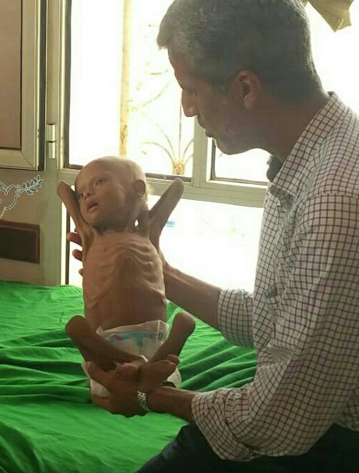 Everyday Every day the number a deaths of children increases in my country #Yemen as a result of acute malnutrition due to the Saudi war &amp; unjust siege at years ago,

Nearly 3 million children suffer from malnourished ....

It must #Stopwar on our children 
#yemencantwait