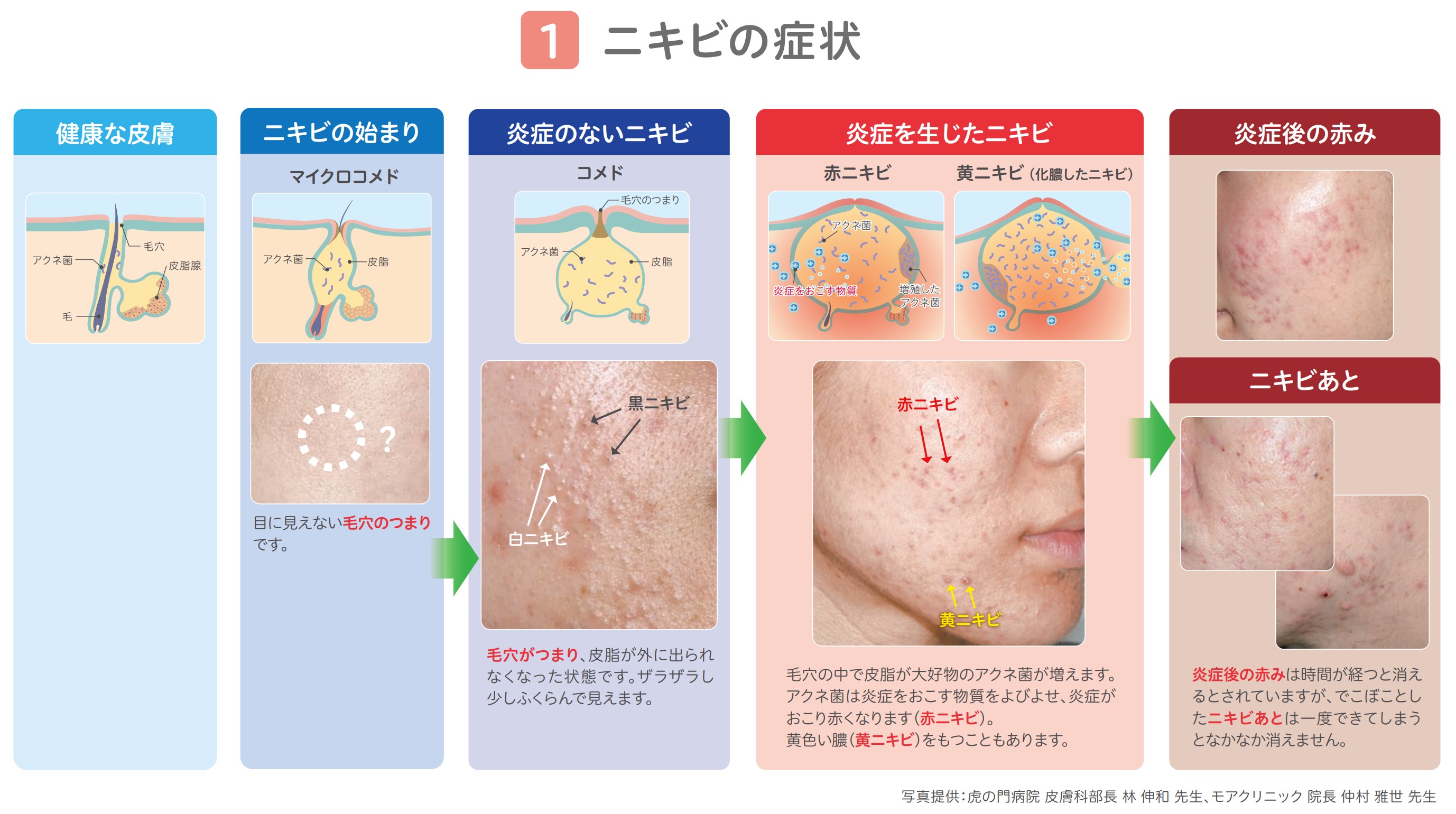 やさひふ 皮膚科専門医 医学博士 Lumedia編集長 タイプ別ニキビ治療 白ニキビ ピーリング系塗り薬 ディフェリン等 赤ニキビ少なめ ピーリング系塗り薬 ベピオ等 抗菌薬の塗り薬 ゼビアックス等 赤ニキビ多め ピーリング系塗り薬