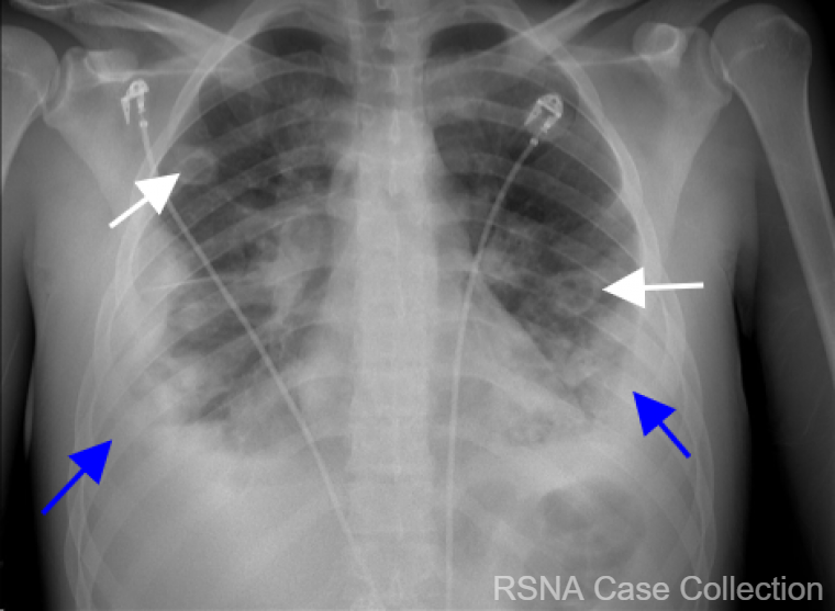 RCC_Editor's tweet photo. It’s the end of “a-lung” week and the answer to the #RSNACC COW is: Lemierre’s Syndrome! https://t.co/mui4d4KgqP 

Thank you #ChestRad DE Dr. Christopher Walker! @KURadiology and authors Drs. Ankit Mohla and Mark DiMarcangelo @ankitmohla @CooperRadResidency @CooperHealthNJ 
@RSNA https://t.co/58SjW12at6