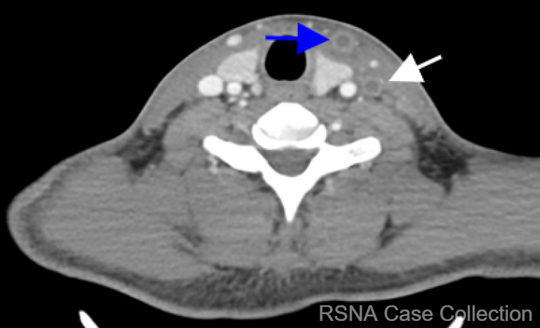 RCC_Editor's tweet photo. It’s the end of “a-lung” week and the answer to the #RSNACC COW is: Lemierre’s Syndrome! https://t.co/mui4d4KgqP 

Thank you #ChestRad DE Dr. Christopher Walker! @KURadiology and authors Drs. Ankit Mohla and Mark DiMarcangelo @ankitmohla @CooperRadResidency @CooperHealthNJ 
@RSNA https://t.co/58SjW12at6