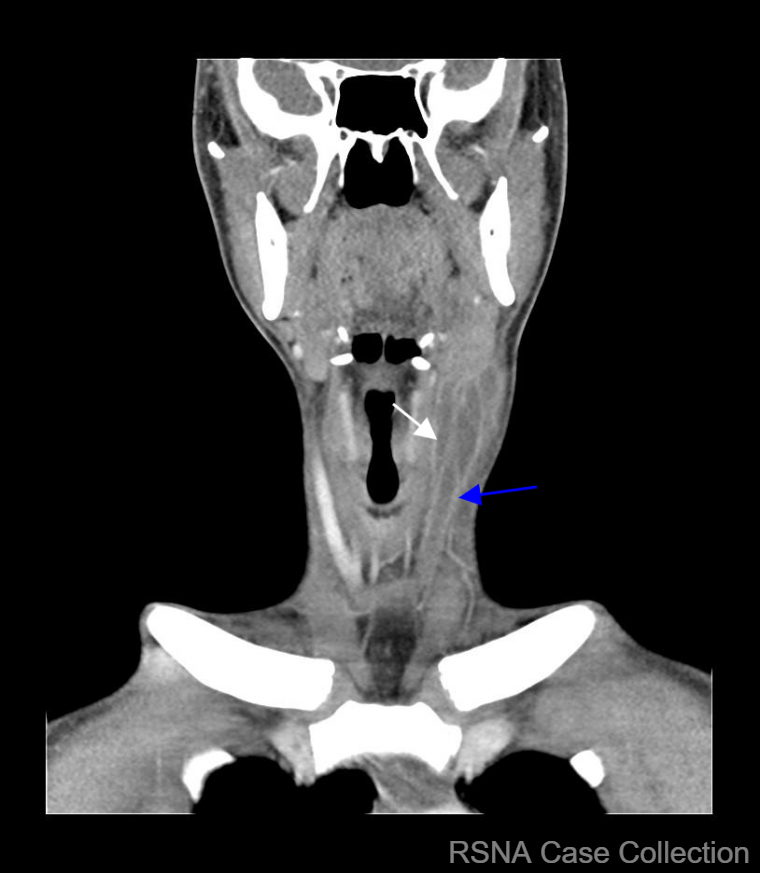 RCC_Editor's tweet photo. It’s the end of “a-lung” week and the answer to the #RSNACC COW is: Lemierre’s Syndrome! https://t.co/mui4d4KgqP 

Thank you #ChestRad DE Dr. Christopher Walker! @KURadiology and authors Drs. Ankit Mohla and Mark DiMarcangelo @ankitmohla @CooperRadResidency @CooperHealthNJ 
@RSNA https://t.co/58SjW12at6
