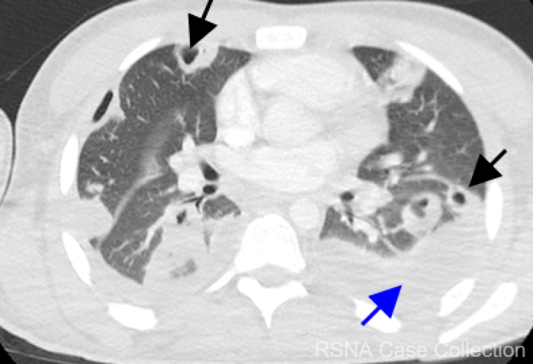 RSNACaseCollection_Editor (@rcc_editor) on Twitter photo It’s the end of “a-lung” week and the answer to the #RSNACC COW is: Lemierre’s Syndrome! bit.ly/2UyBBrK
Thank you #ChestRad DE Dr. Christopher Walker! <a href="/KURadiology/">KU Radiology</a> and authors Drs. Ankit Mohla and Mark DiMarcangelo <a href="/ankitmohla/">Ankit Sharma</a> @CooperRadResidency <a href="/CooperHealthNJ/">Cooper University Health Care</a>
<a href="/RSNA/">RSNA</a> It’s the end of “a-lung” week and the answer to the #RSNACC COW is: Lemierre’s Syndrome! bit.ly/2UyBBrK
Thank you #ChestRad DE Dr. Christopher Walker! <a href="/KURadiology/">KU Radiology</a> and authors Drs. Ankit Mohla and Mark DiMarcangelo <a href="/ankitmohla/">Ankit Sharma</a> @CooperRadResidency <a href="/CooperHealthNJ/">Cooper University Health Care</a>
<a href="/RSNA/">RSNA</a>