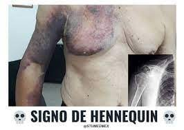 dra_khaleesi's tweet photo. hematoma de hennequin: equimosis localizada en cara interna del brazo y cara externa del torax= fx de humero proximal. https://t.co/C2NHulyE9T