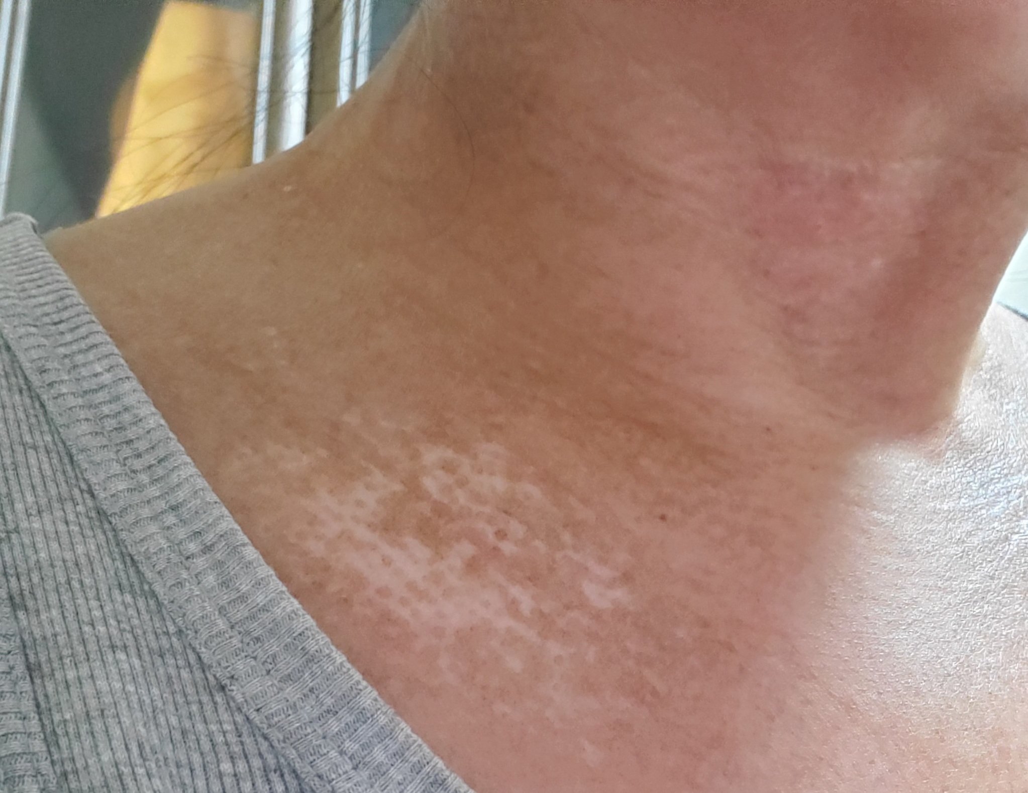 Amelie 皮膚硬化はお腹にまで及んでいます 指は太くパツパツ 腕はまだら模様に 色白だった顔は薄黒く 所々 色抜けしています 大きい目 の筈だった片目が小さくなってしまいました 首 きたないので躊躇しましたが こんな感じです 昨日は腕と顔