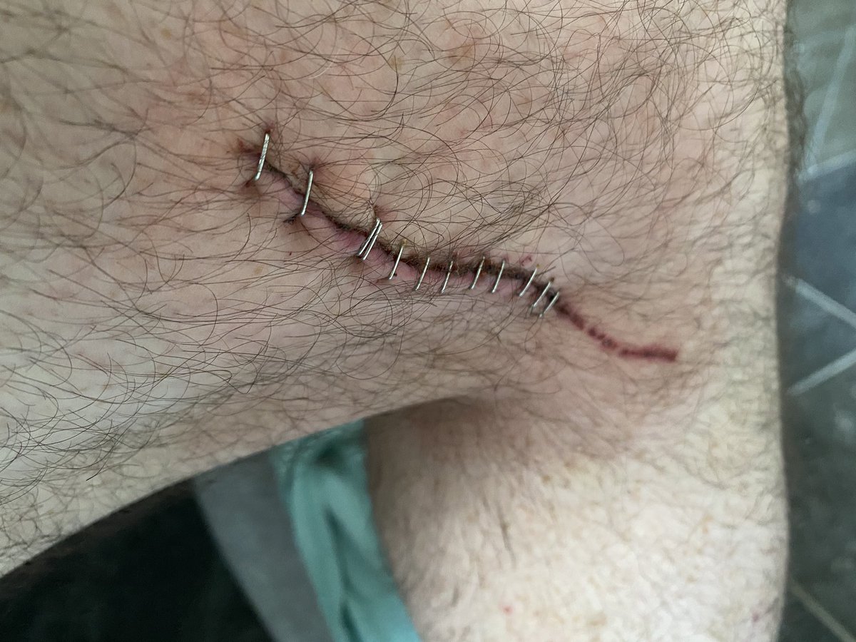 BareNolze's tweet photo. @TrampaMusic @olliebarenoize Stapled her up nice. Surprisingly painless tbh https://t.co/1tv0Lpjlxc
