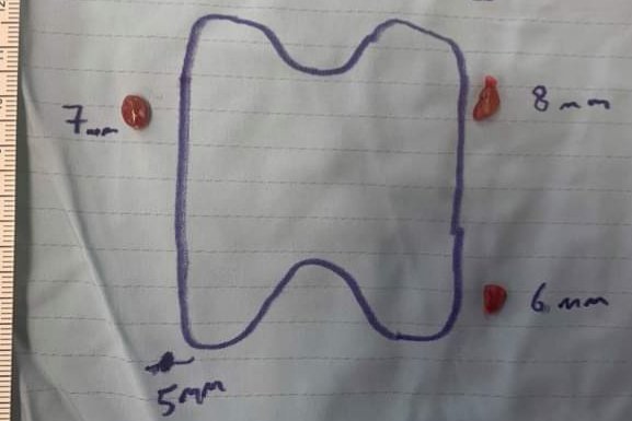 SpSallie's tweet photo. A guy named Guy shared this image yesterday after surgery in Oxford by @ShadKhanSurgeon Biochemically normal 4 gland hyperplasia. Highest calcium 2.56 (2.15-2.5) highest PTH 4.42 (1.6-6.9). Guy has been very unwell for 15 years. Lessons must be learnt  #ItsNotAllAboutTheLevels https://t.co/zB8iqyPqCM