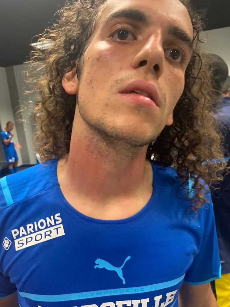ActuFoot_'s tweet photo. Luan Peres a été touché au cou durant les échauffourées.

Deux autres joueurs marseillais sont blessés.

📸 @RMCsport #OGCNOM https://t.co/AANTTjqo98