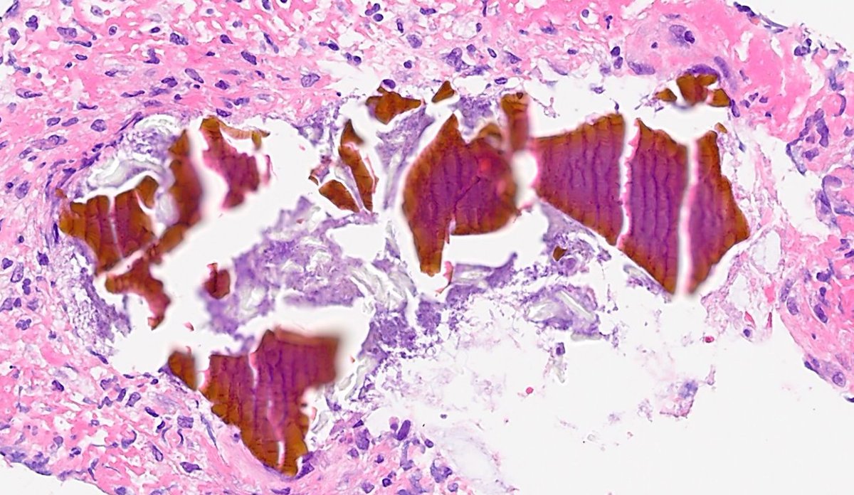 older M, bloody diarrhea, colonoscopy: r/o ischemia

after🔬review, chart lookup🖥️showed patient has renal disease &amp; on Renvela (sevelamer)

▶️2-tone 🐟scale appearance of these crystals can be incidental finding in #GIpath bx, but can cause mucosal injury
pubmed.ncbi.nlm.nih.gov/24061514/