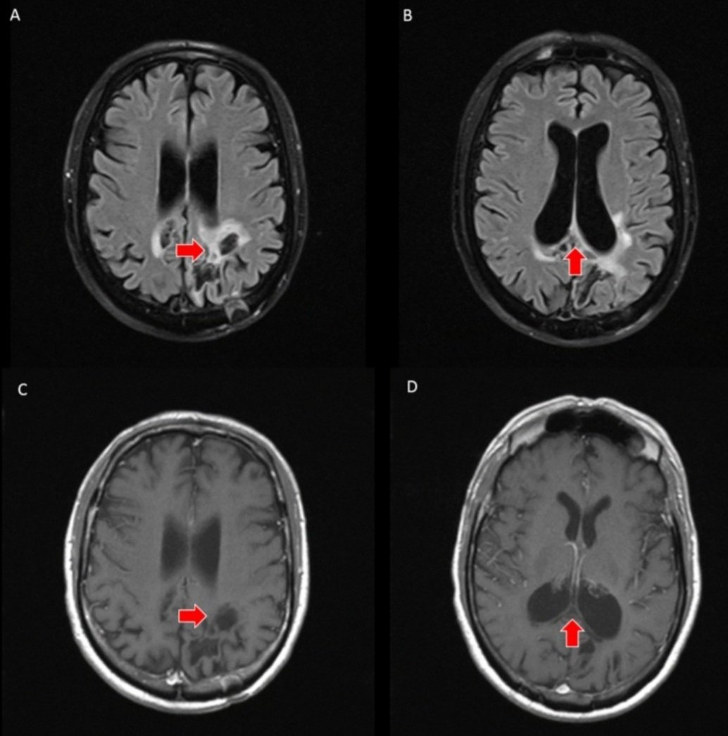 Looks different in immuno-deficient: Primary 🧠 #Lymphoma may lack uniform hypercellularity on #MRI & show edge enhancement & necrosis similar to tumefactive demyelination ⬇️ 

Bx ➕ PCNSL Before & 5 mo. s/p chemo (last pic) #radres #FOAMrad #neurorad #neuroncology #neurology