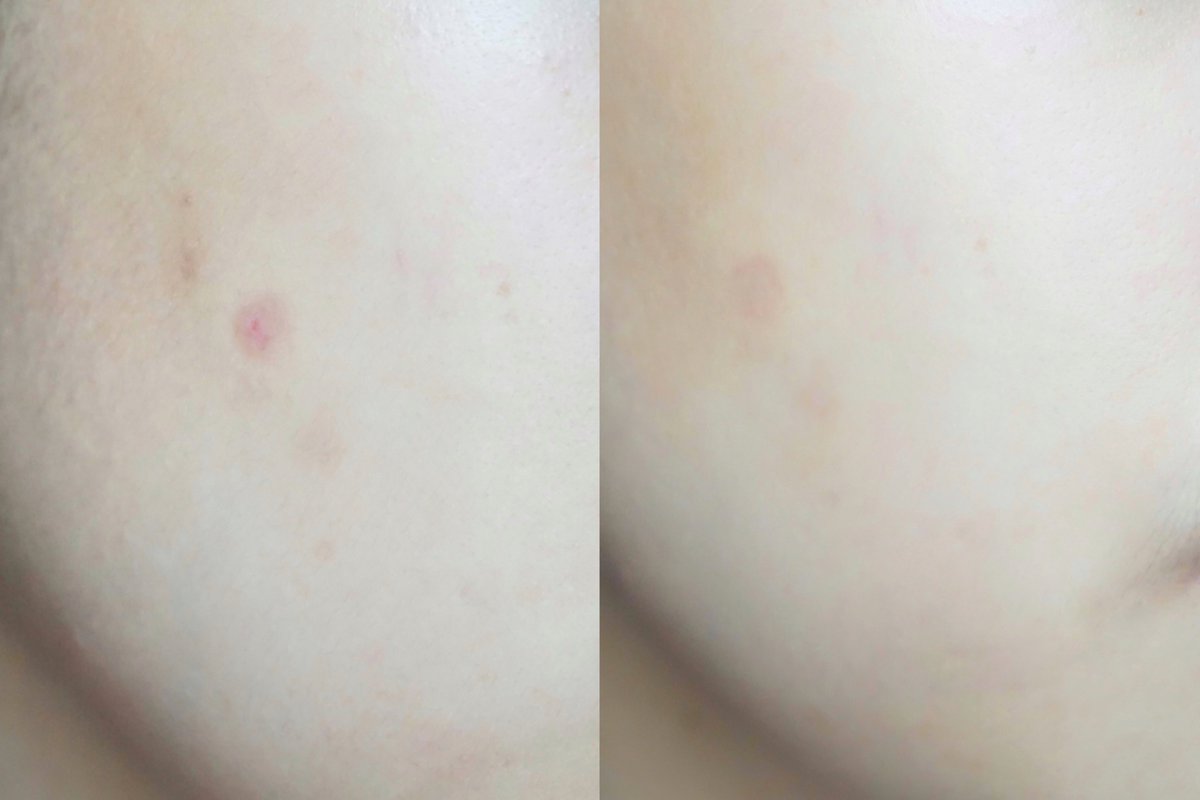 ซื้อซ้ำแล้วคับ ไม่นอกใจแล้ว หลังจากนอกใจไปใช้แบรนด์อื่นมาช่วงนึง กลับมาซื้อใหม่อีกรอบ เพราะของ Puricas dragon's blood ลดรอยสิวเห็นผลไวกว่ามากๆ🥺 ใครรอยสิวหายยากๆ ยังไม่ลอง ลองด่วน ตัวนี้ใช้ดีจริงๆ มาคอนเฟิร์ม 2 วีคคือเห็นผลเลย #ใช้ดีบอกต่อ