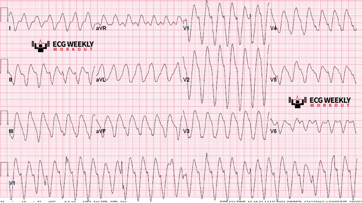 ECGWeekly's tweet image. A 41yo is brought to the ED and is febrile, normotensive (126/78), tachycardic (120s-150s), tachypneic and POC glucose = “high”. The following ECG is obtained that shows a wide complex tachycardia. What is your differential for this wide complex tachycardia?