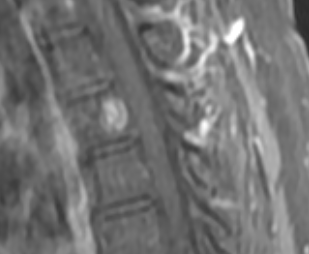 JackJalloMD's tweet photo. #costotransversectomy: great way to perform corpectomy to surgically resect vertebral body pathologies. We used this approach followed by placement of expandable cage to treat locally aggressive #hemangioma w/significant epidural extension &amp; cord compression @TJUHNeurosurg https://t.co/zcxch4nBDq