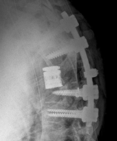 JackJalloMD's tweet photo. #costotransversectomy: great way to perform corpectomy to surgically resect vertebral body pathologies. We used this approach followed by placement of expandable cage to treat locally aggressive #hemangioma w/significant epidural extension &amp; cord compression @TJUHNeurosurg https://t.co/zcxch4nBDq