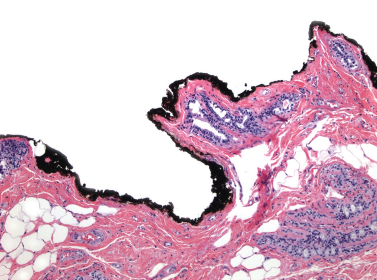 VectorSurgical's tweet image. Intraoperative inking of margins with #MarginMarker increased the agreement rate between the surgeon and pathologist when compared to suture, according to research by @UMNSurgOnc in The Breast Journal. #surgeon #pathologist @AltmanAriella @JHuiMD 
doi.org/10.1111/tbj.13…