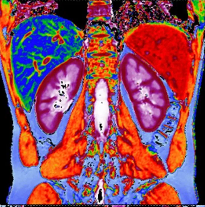 mitcharj's tweet photo. Fascinating work by @PerspectumGroup on the use of AI and MRI to identify people at risk of #LongCovid. Watch from 18 minutes https://t.co/QdHlbtx2g1 #Coverscan #digitalhealth #AI #MRI @innovateuk https://t.co/fXJAbBX2bp