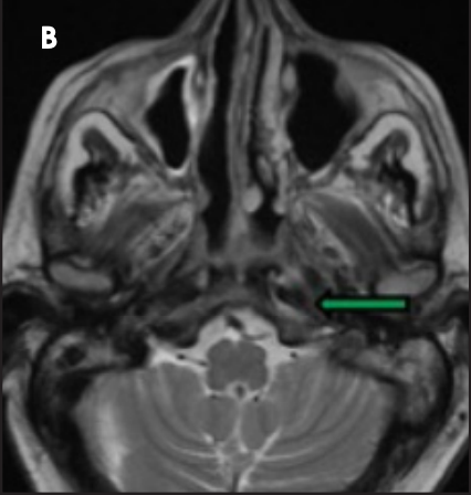 Applied_Rad's tweet photo. MR Community Focus: Inflammatory pseudotumor of the nasopharynx is a rare mimicker of nasopharyngeal carcinoma and other neoplastic and infectious lesions involving the skull base. Learn more > https://t.co/2Y71G4WE32 #MRI #NeuroRads #MRTechs #RadRes #braccoimaging https://t.co/4WLO8jLJsD