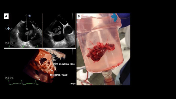 datsunian's tweet photo. Out in @avsgjournal from @uclaVIR @TylerCalleseMD @JonnyMoriarty & @uclaimchiefs #dannyobrien
Safety of RA thrombus #Angiovac in CA vs non-CA pts
High risk groups overall but no sig differences in survival/technical success
#bruinhearts #cardioonc
https://t.co/NVL4zmVAA3 https://t.co/QWKdm5mucV