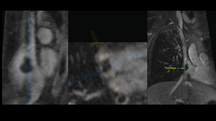 datsunian's tweet photo. Out in @avsgjournal from @uclaVIR @TylerCalleseMD @JonnyMoriarty & @uclaimchiefs #dannyobrien
Safety of RA thrombus #Angiovac in CA vs non-CA pts
High risk groups overall but no sig differences in survival/technical success
#bruinhearts #cardioonc
https://t.co/NVL4zmVAA3 https://t.co/QWKdm5mucV