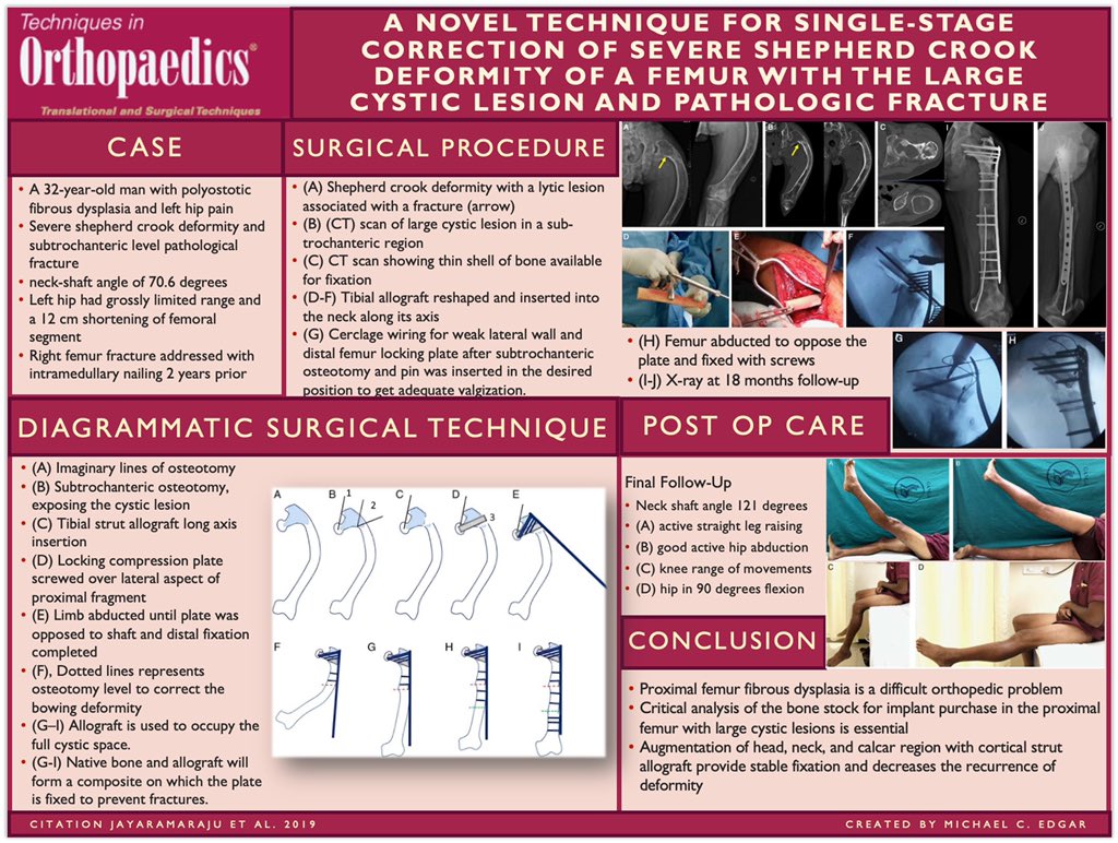 Our latest #VisualAbstract is out! "A Novel Technique for Single-Stage Correction of Severe Shepherd Crook Deformity of a Femur with the Large Cystic Lesion and Pathologic Fracture”

#Orthopedics #orthotwitter #orthopaedics #orthopedicsurgery