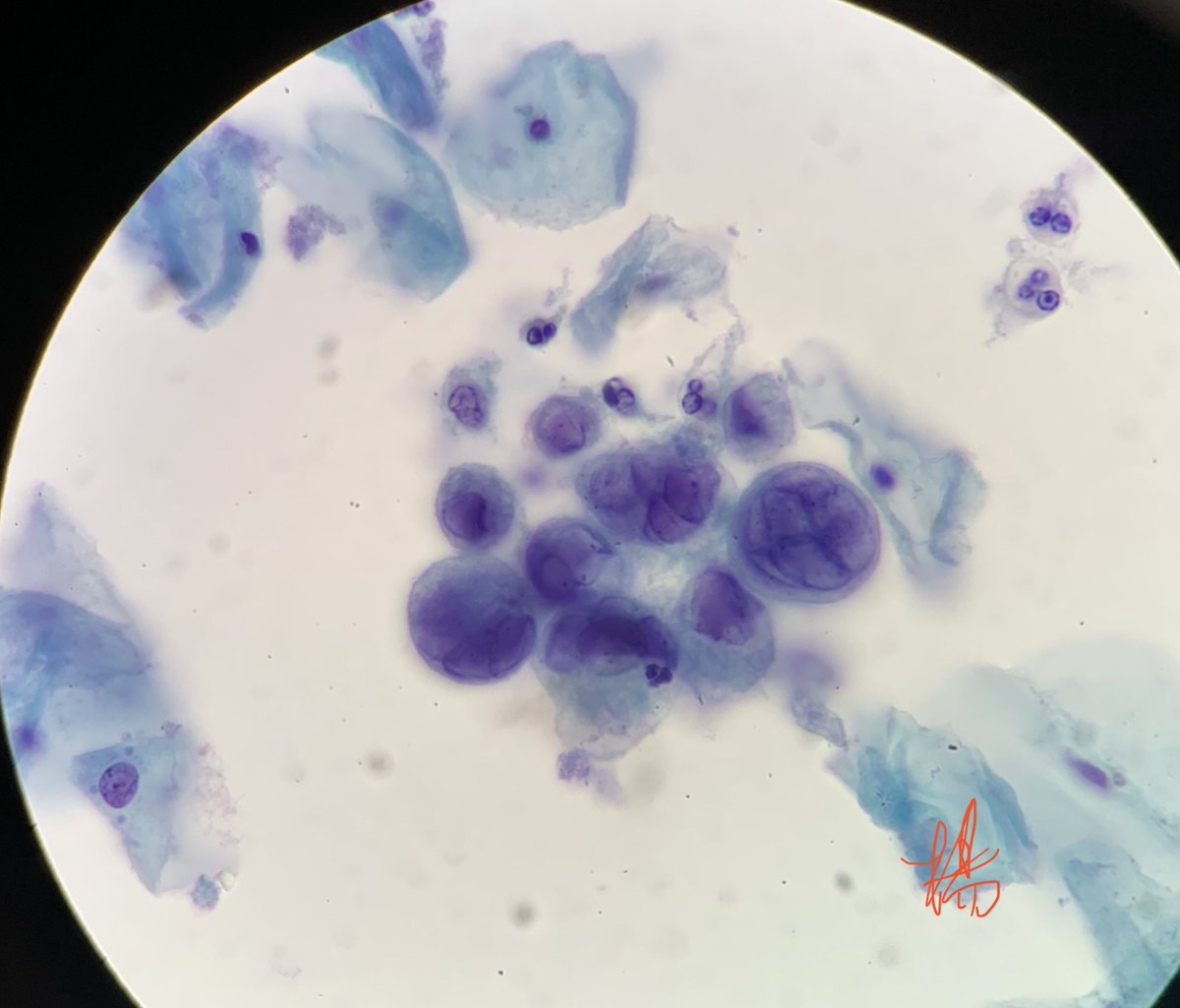 HENRYY_MD's tweet photo. This has got to be the most beautiful Herpes I have ever seen in a PAP smear ( of course I’ve seen many in skin tissue sections😜)#pathology  #cytopath #virocytopathic https://t.co/XQEWmWhgbV