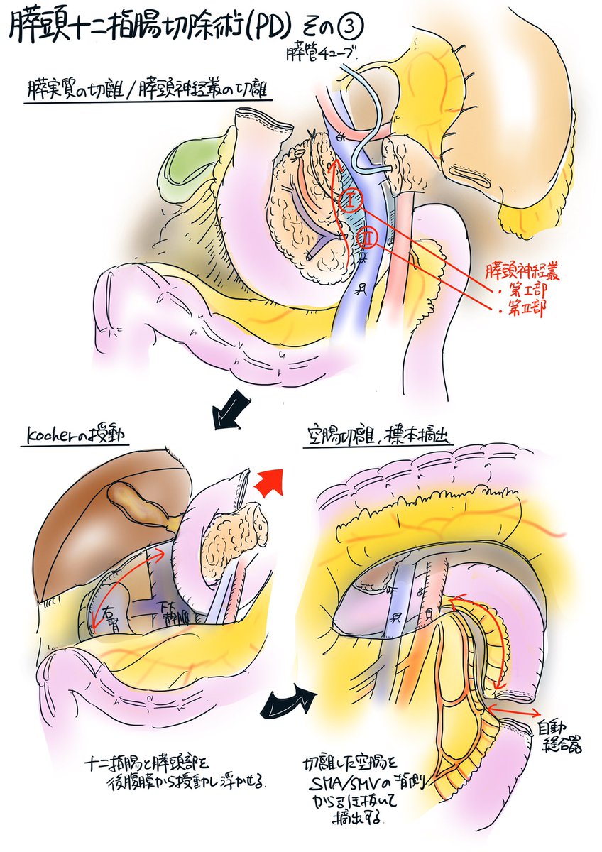 膵頭十二指腸切除臓器手作りキーホルダー看護