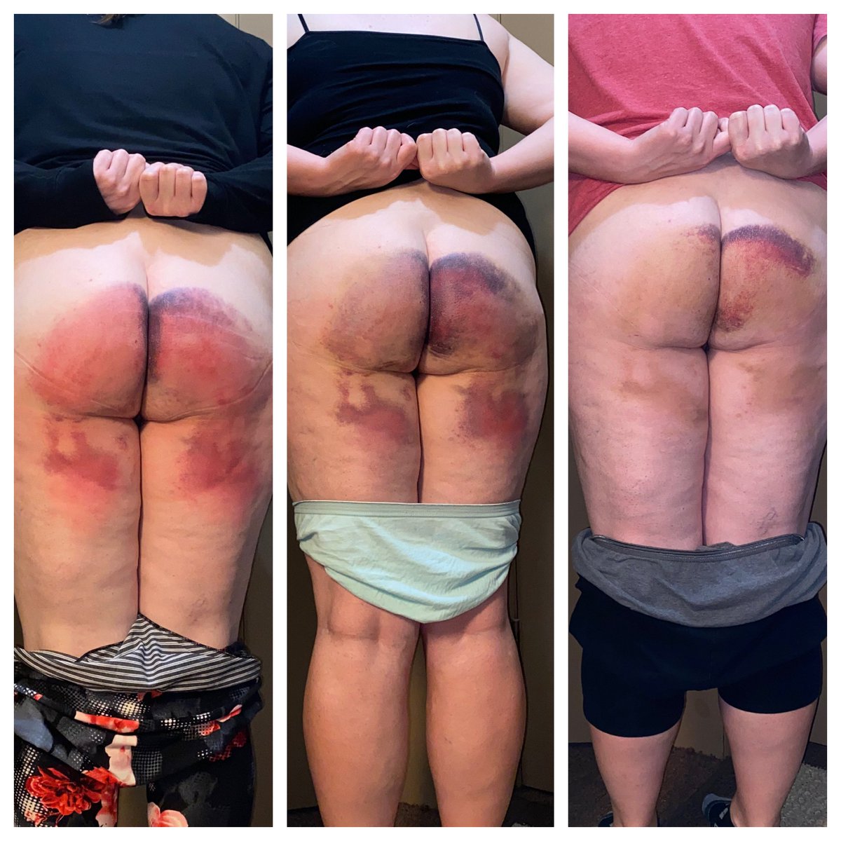 Lynn83marie's tweet photo. The progression of the bruises from my last spanking from @Cp7Daddy.  Let’s just say my behavior this last week has been stellar!!  #tryingtobehave #punishments #otk #ouch #spanking https://t.co/1YCO2jq18W